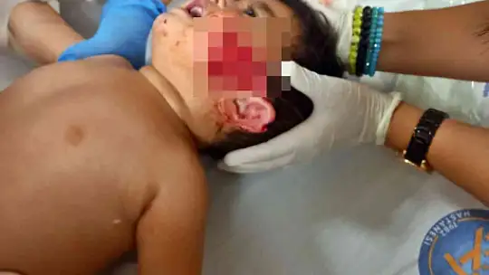 11 aylıkken pitbull saldırısına uğrayan minik Sadrettin, anne kelimesinden önce 'acıyor'u öğrendi