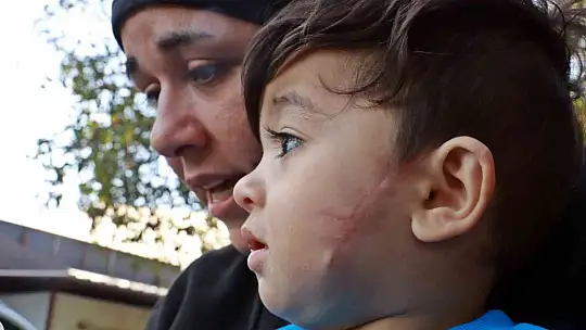 11 aylıkken pitbull saldırısına uğrayan minik Sadrettin, anne kelimesinden önce 'acıyor'u öğrendi