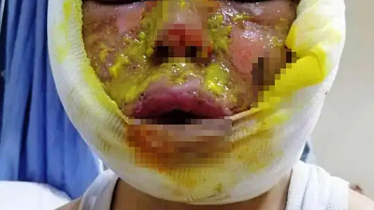 4 çocuğun mazot dolu tenekeyle oyunu faciayla bitti