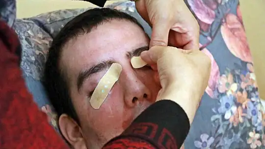 8 yıldır gözlerini kırpamıyor, adeta kan ağlıyor