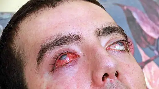 8 yıldır gözlerini kırpamıyor, adeta kan ağlıyor