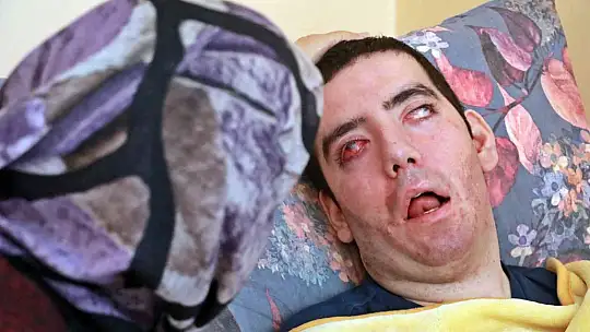 8 yıldır gözlerini kırpamıyor, adeta kan ağlıyor