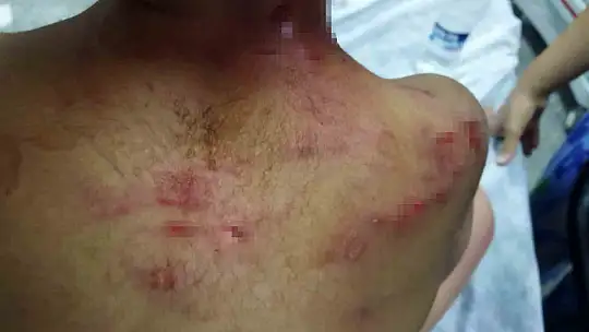 Köpeğin saldırısına uğrayan çocuğun kafasında derin yaralar oluştu