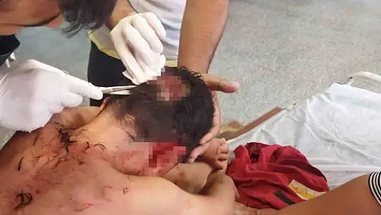 Köpeğin saldırısına uğrayan çocuğun kafasında derin yaralar oluştu