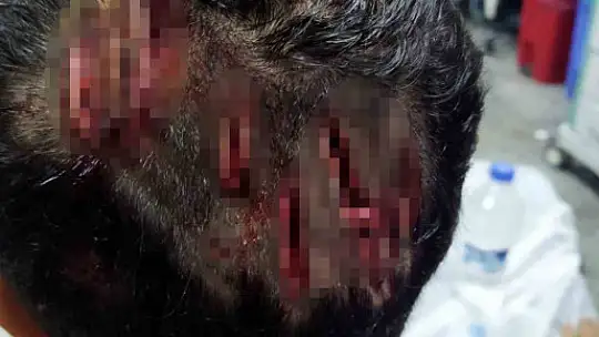 Köpeğin saldırısına uğrayan çocuğun kafasında derin yaralar oluştu