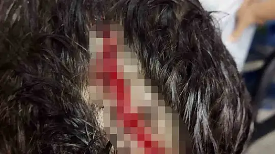 Köpeğin saldırısına uğrayan çocuğun kafasında derin yaralar oluştu