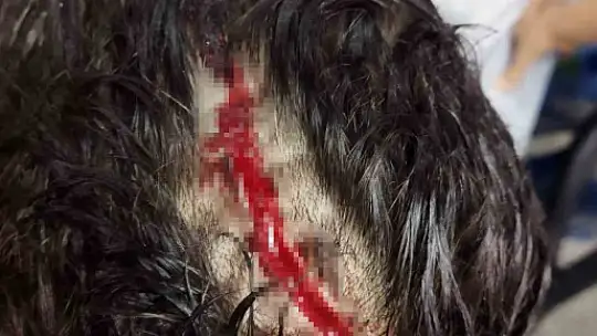 Sokak köpeği saldırısında ağır yaralanan çocuktan 'köpekler toplansın' çağrısı