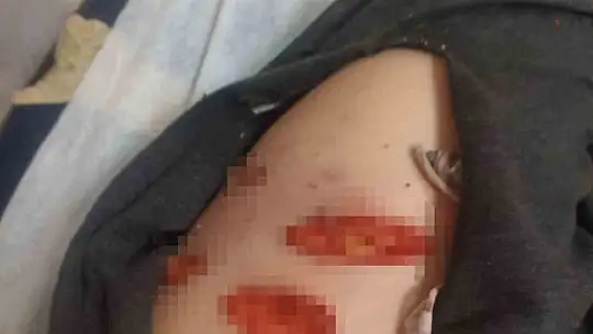 Sokak köpeğinin saldırısına uğrayan çocuk ölümden döndü