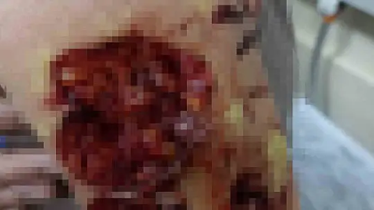 Sokak köpeğinin saldırısına uğrayan çocuk ölümden döndü