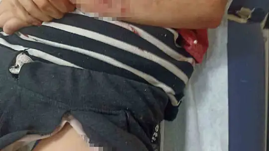 Sokak köpeğinin saldırısına uğrayan çocuk ölümden döndü