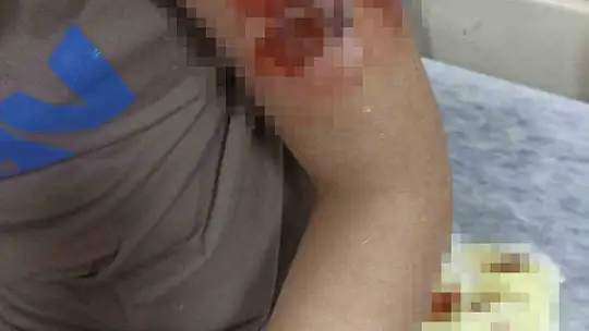 Sokak köpeğinin saldırısına uğrayan çocuk ölümden döndü
