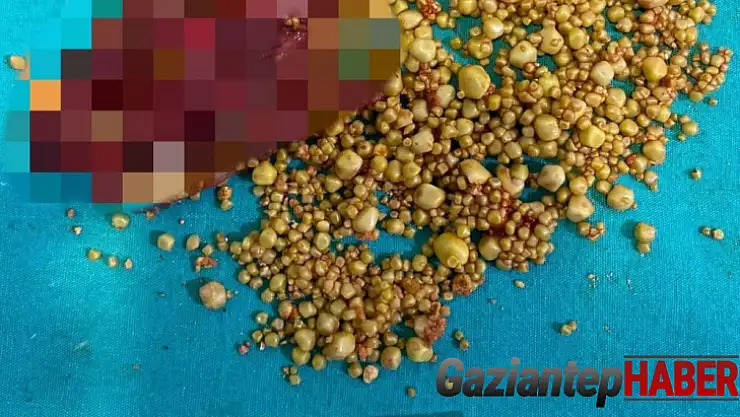 76 yaşındaki hastanın safra kesesinden bin 284 taş çıktı
