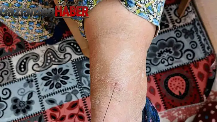 Ayak topuğundan 37 santim tel çıktı